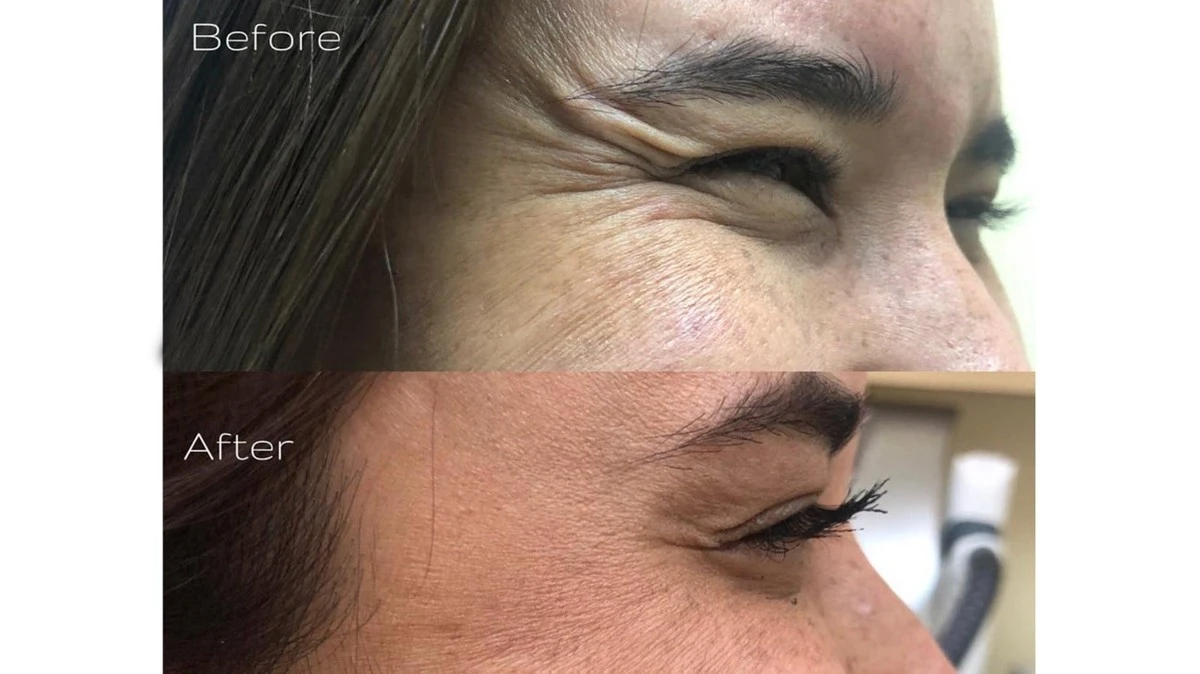 Kolik stojí v roce 2026 preventivní botox po třicítce? - image 1