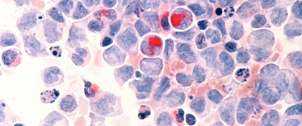 Proč vědci chtějí sledovat fragmenty DNA v krvi desetiletí před vznikem nádoru - image 1