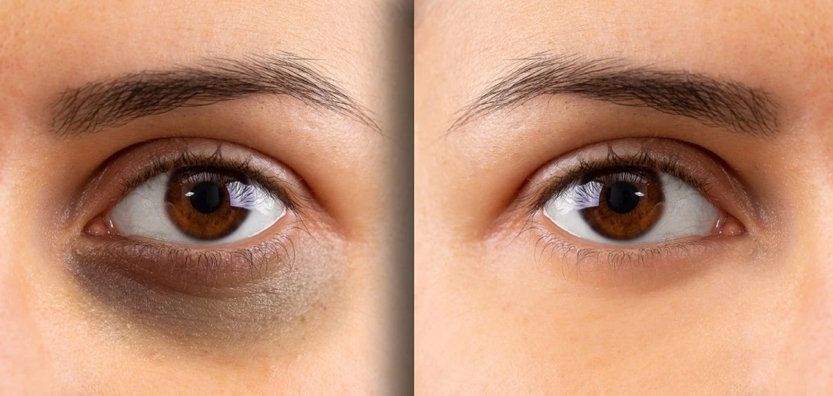 Kolik stojí laserové odstranění kruhů pod očima v roce 2026: Cena za pohled bez únavy - image 1