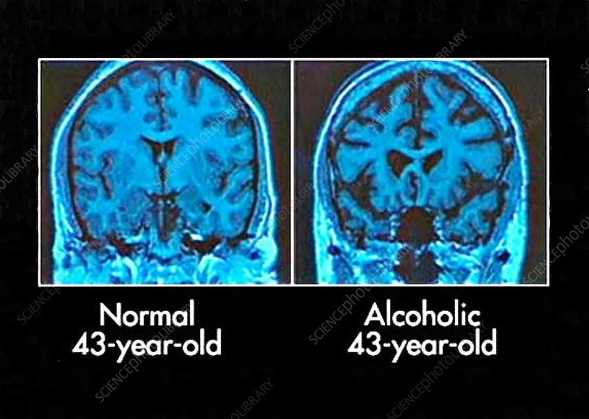 Proč diagnóza rakoviny u lidí spouští sklon ke kriminalitě a co s mozkem dělá jedna sklenka - image 1